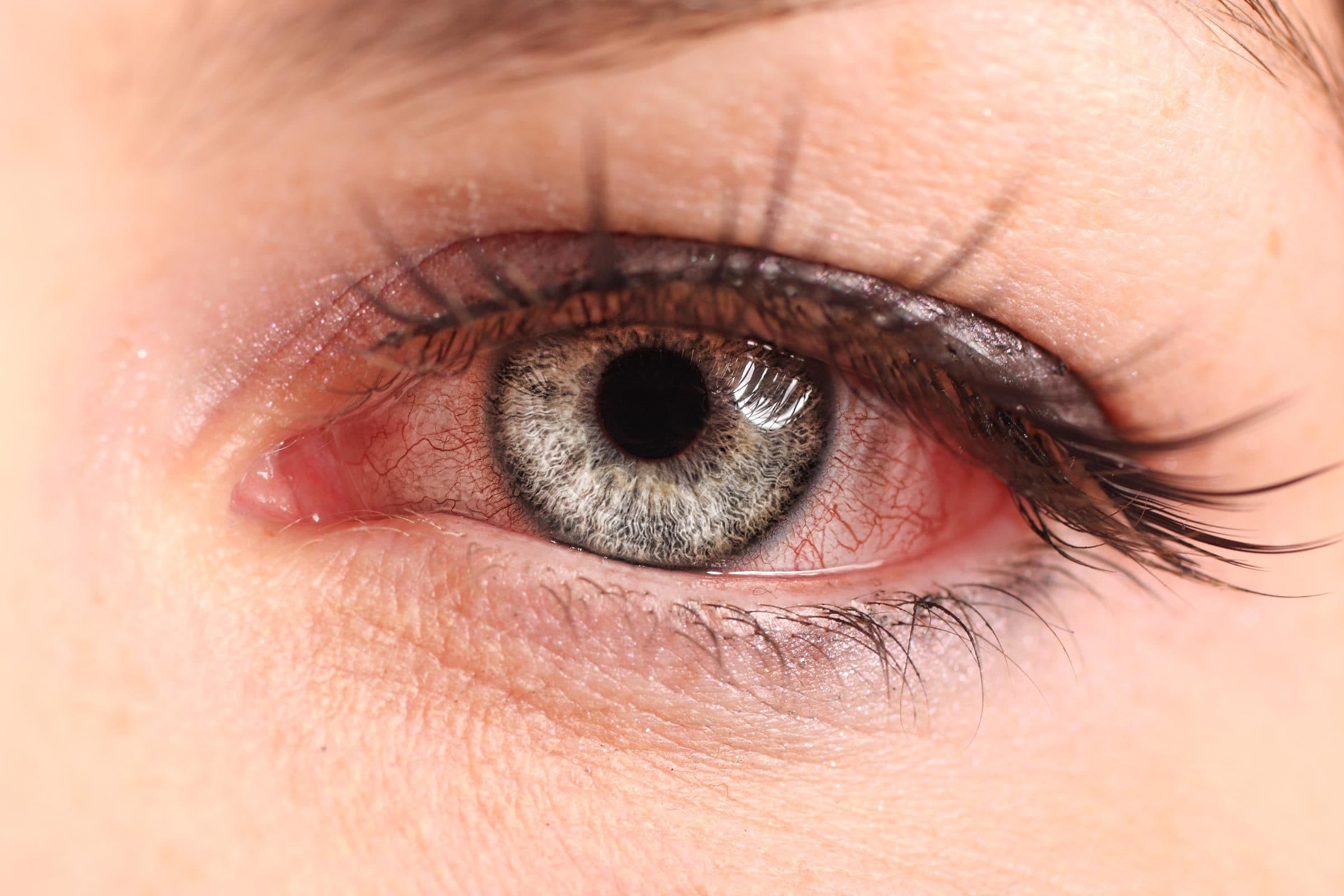 Oakland Red Eyes Care - olive + spex optometry